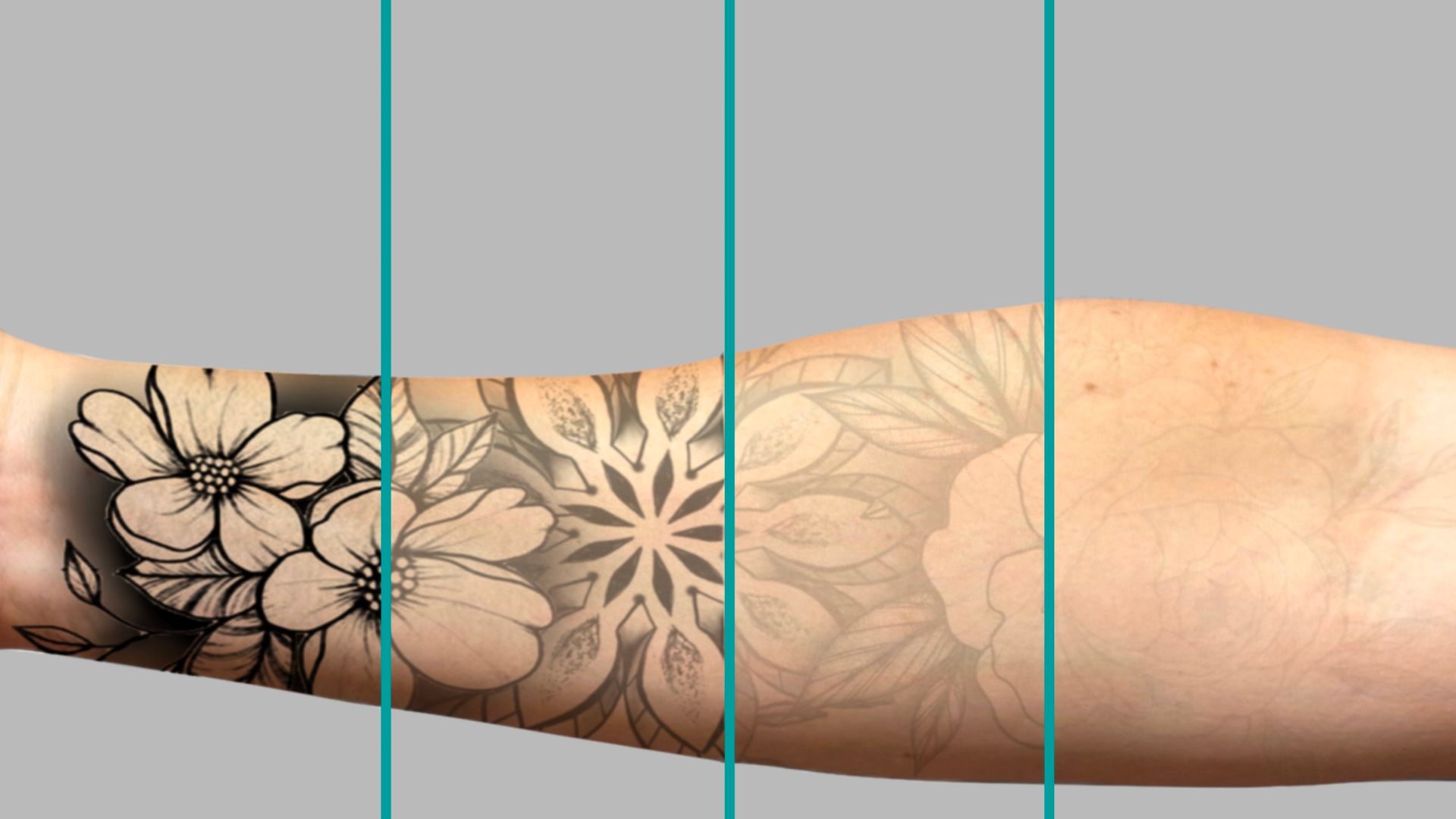 Laser - Tattoo Removal